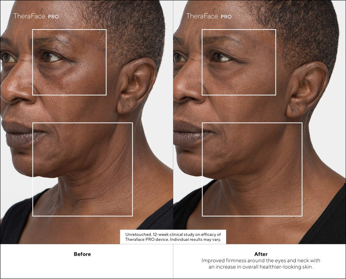 Masajeador  Therabody Theraface Pro Cara Negro