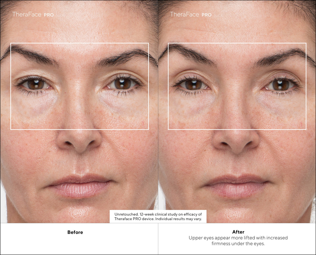 Masajeador  Therabody Theraface Pro Cara Negro