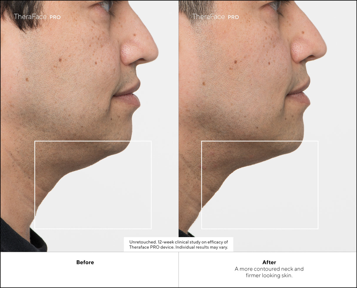 Masajeador  Therabody Theraface Pro Cara Negro