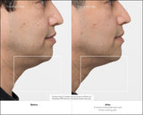 Masajeador  Therabody Theraface Pro Cara Negro